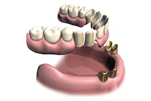 Implantatgetragener Teleskopprothese