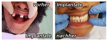 Implantate vorher-nachher