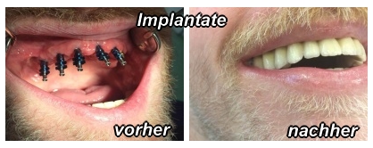 Implantate vorher-nachher