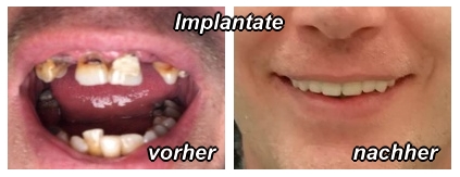 Implantate vorher-nachher