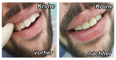 Krone vorher-nachher