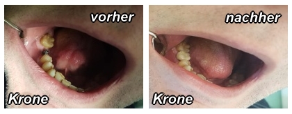 Krone vorher-nachher