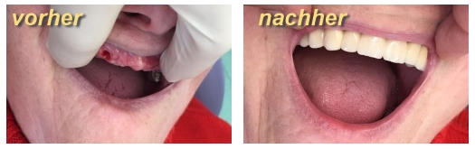 Implantate vorher-nachher