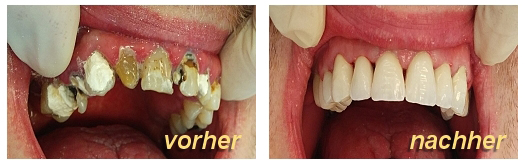 Implantate vorher-nachher